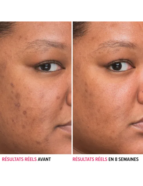 Bye Bye Dark Spots