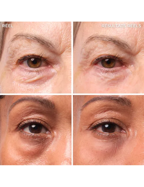 Bye Bye Under Eye Bags